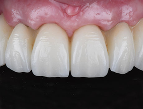 NO BONE REDUCTION